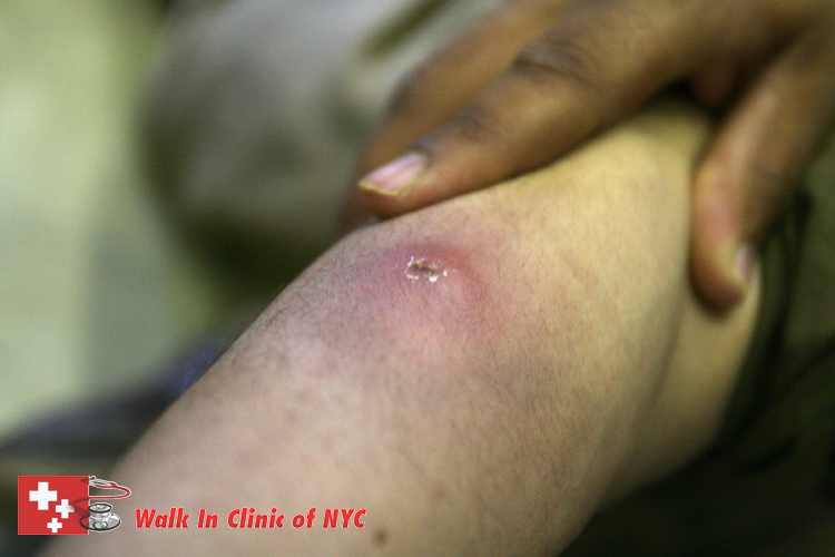 Skin Abscesses Urgent Care Clinic